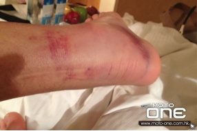 史東拿(Casey Stoner)腫得像豬蹄的足踝